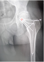 Orthopädische und Sportorthopädische Operationen